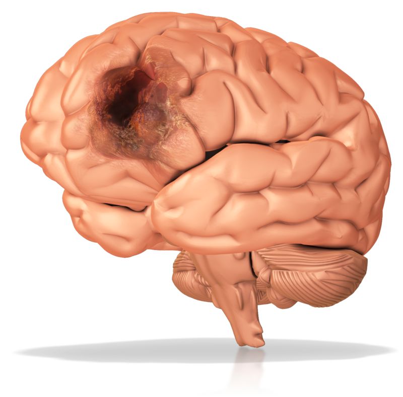 BrainTumorLog